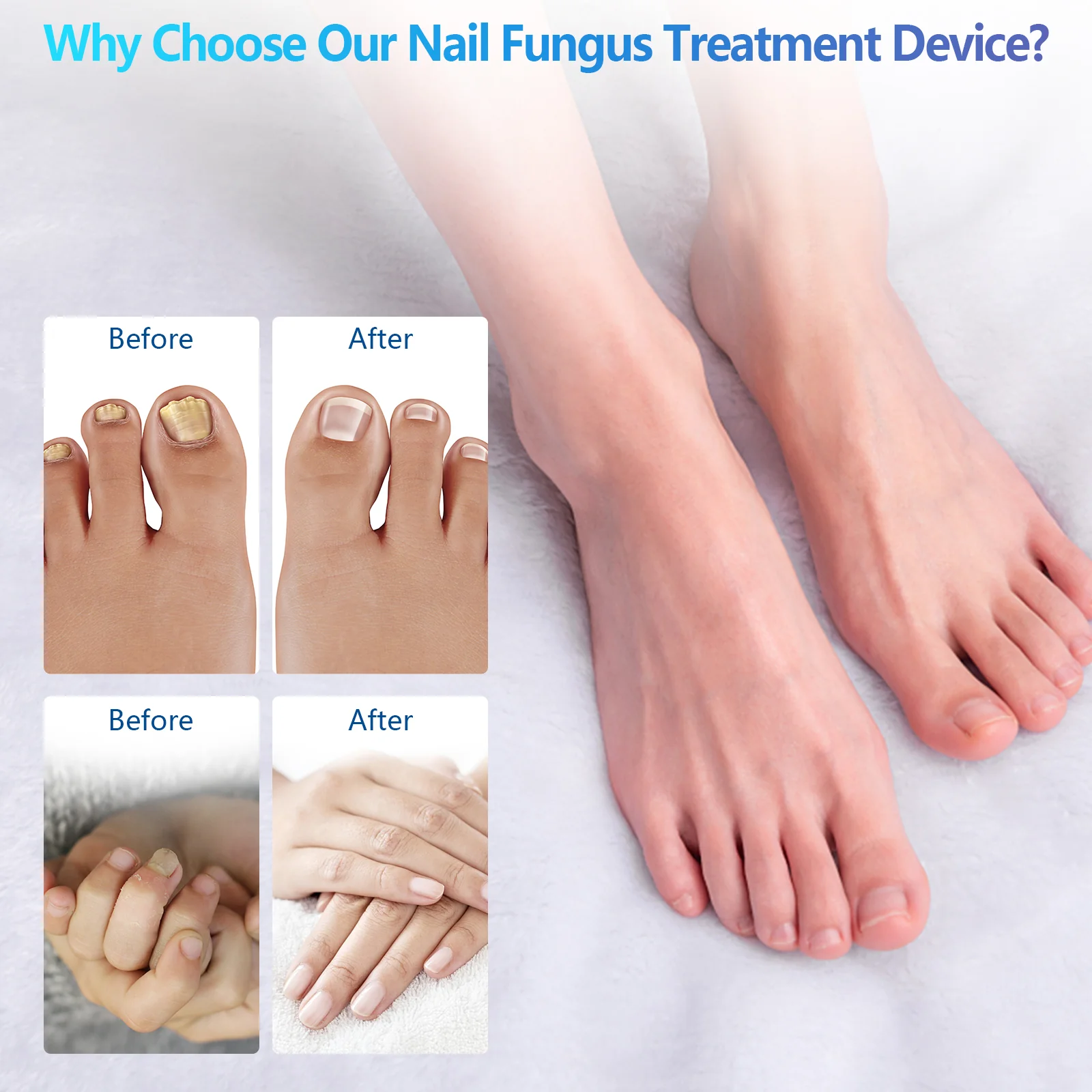 FDA Cleared Portable Laser Therapy Nail Cleaning Device - Image 4