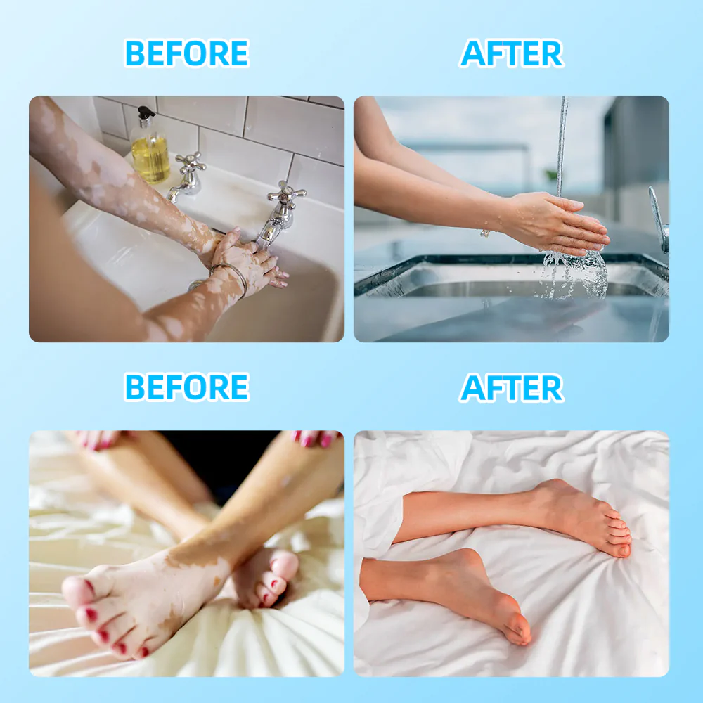 KTS 308nm UVB excimer light therapy apparatus - Image 7