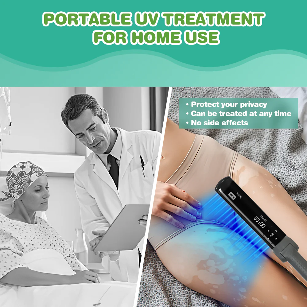 KTS 311nm UVB light therapy treatment for psoriasis vitiligo - Image 4