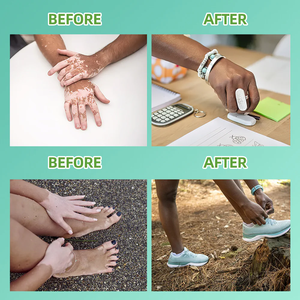 KTS 311nm UVB light therapy treatment for psoriasis vitiligo - Image 6