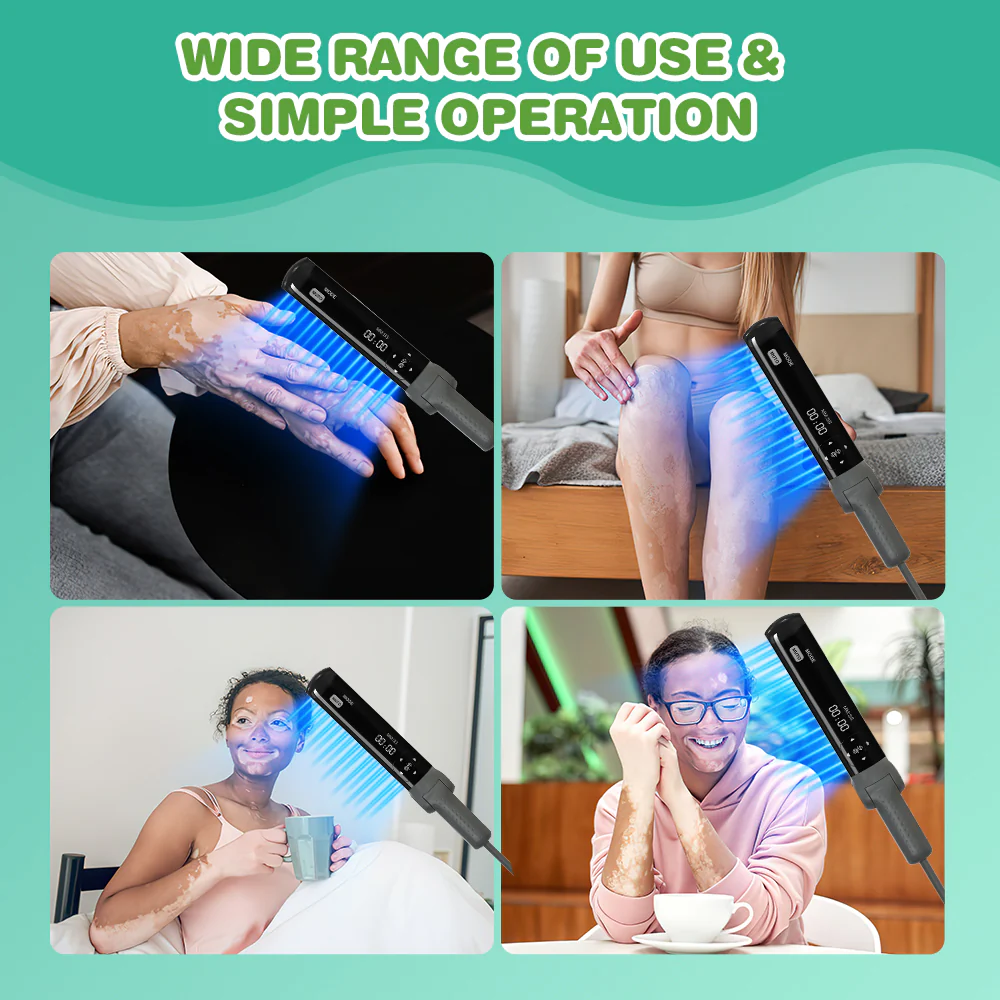 KTS 311nm UVB light therapy treatment for psoriasis vitiligo - Image 7