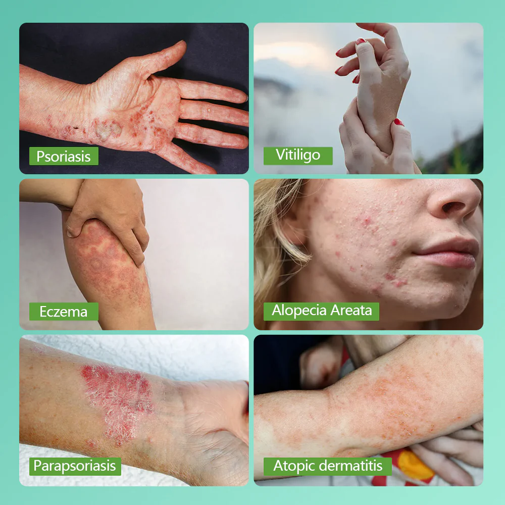 KTS 311nm UVB light therapy treatment for psoriasis vitiligo - Image 9