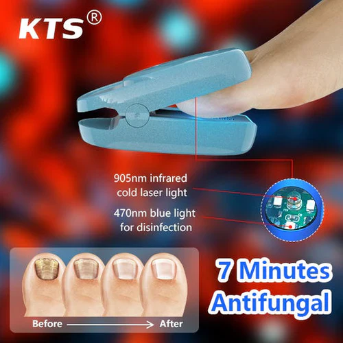 KTS® New Onychomycosis Laser Treatment Device - Image 10