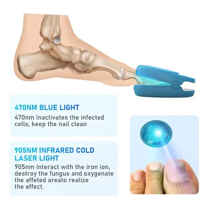 KTS® New Onychomycosis Laser Treatment Device - Image 5