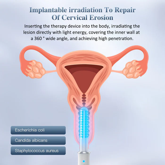KTS® Portable Vaginal Rejuvenation Wand - Image 6