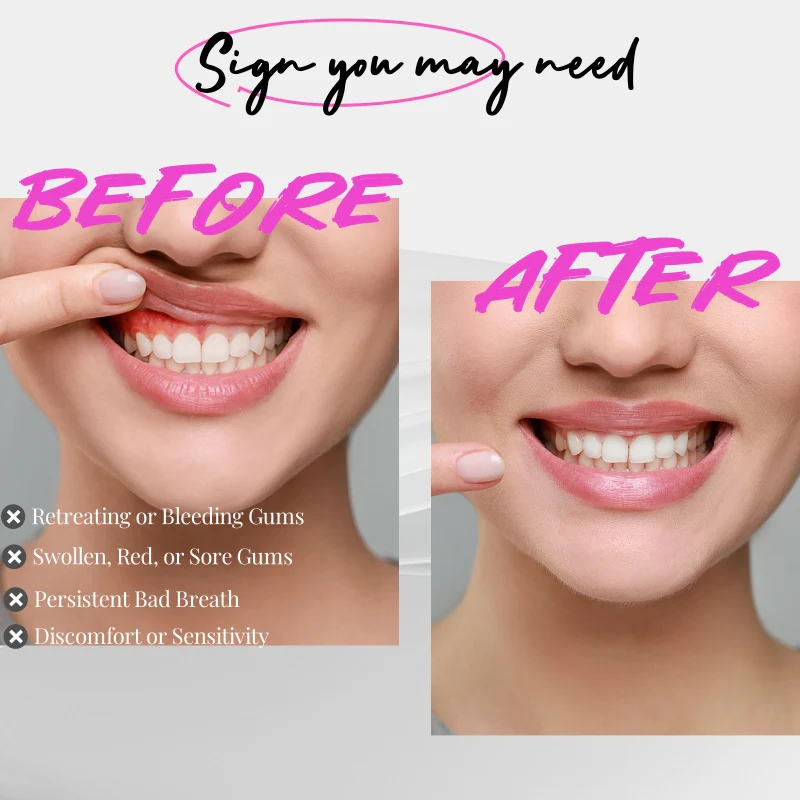 Red & Blue Light Therapy For Gums - Image 4